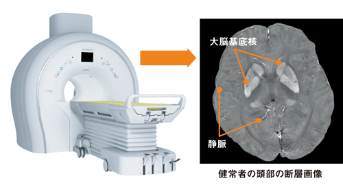 MRIで原因物質を確認<br /> <span>●日立製作所の新技術「QSM」の使用イメージ</span>