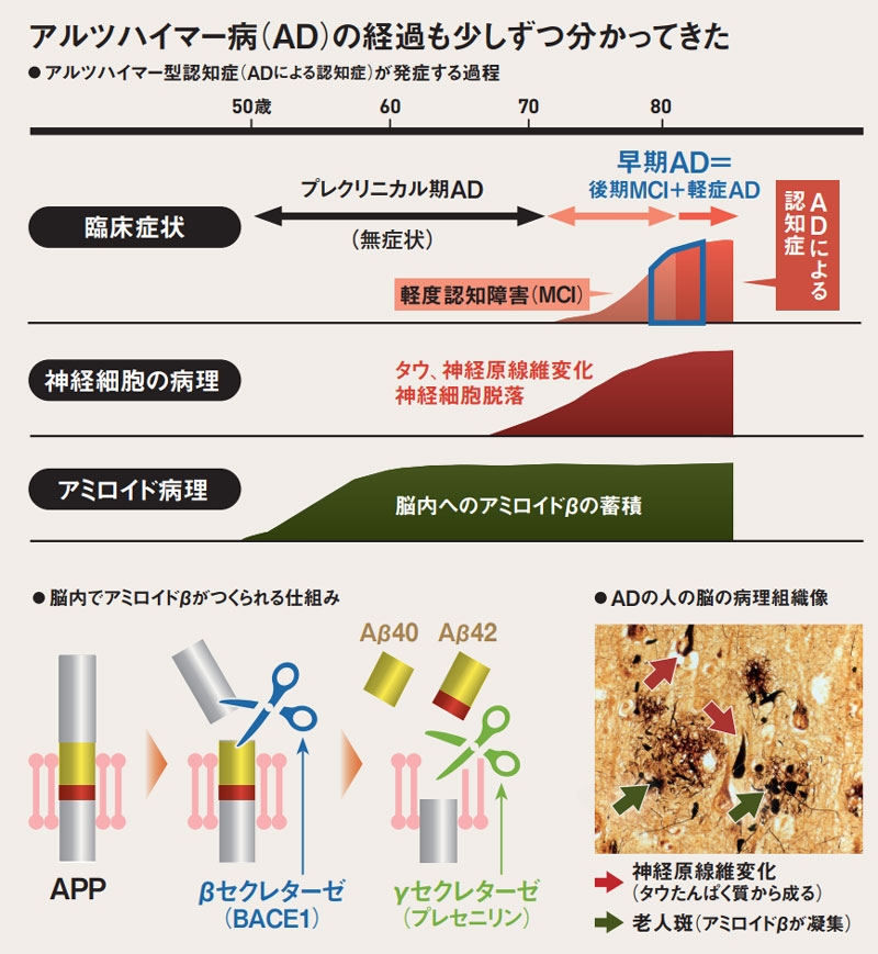 アルツハイマー病、原因はAβかタウたんぱく質か 東大岩坪威教授