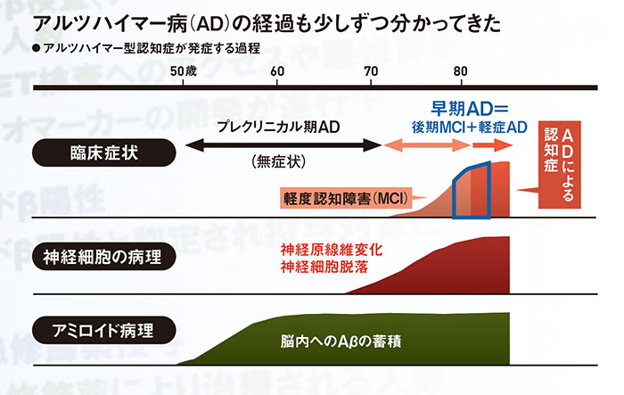 認知症治療、新薬に世界が注目 診断薬市場にも動き：日経