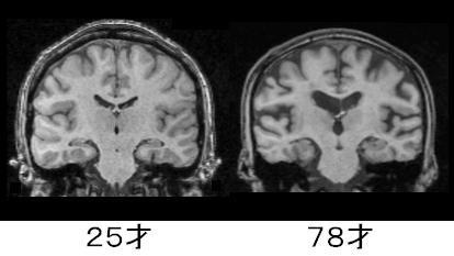 20代の脳と70代の脳の比較
