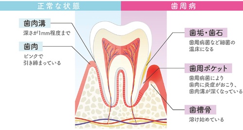 歯周病のメカニズム