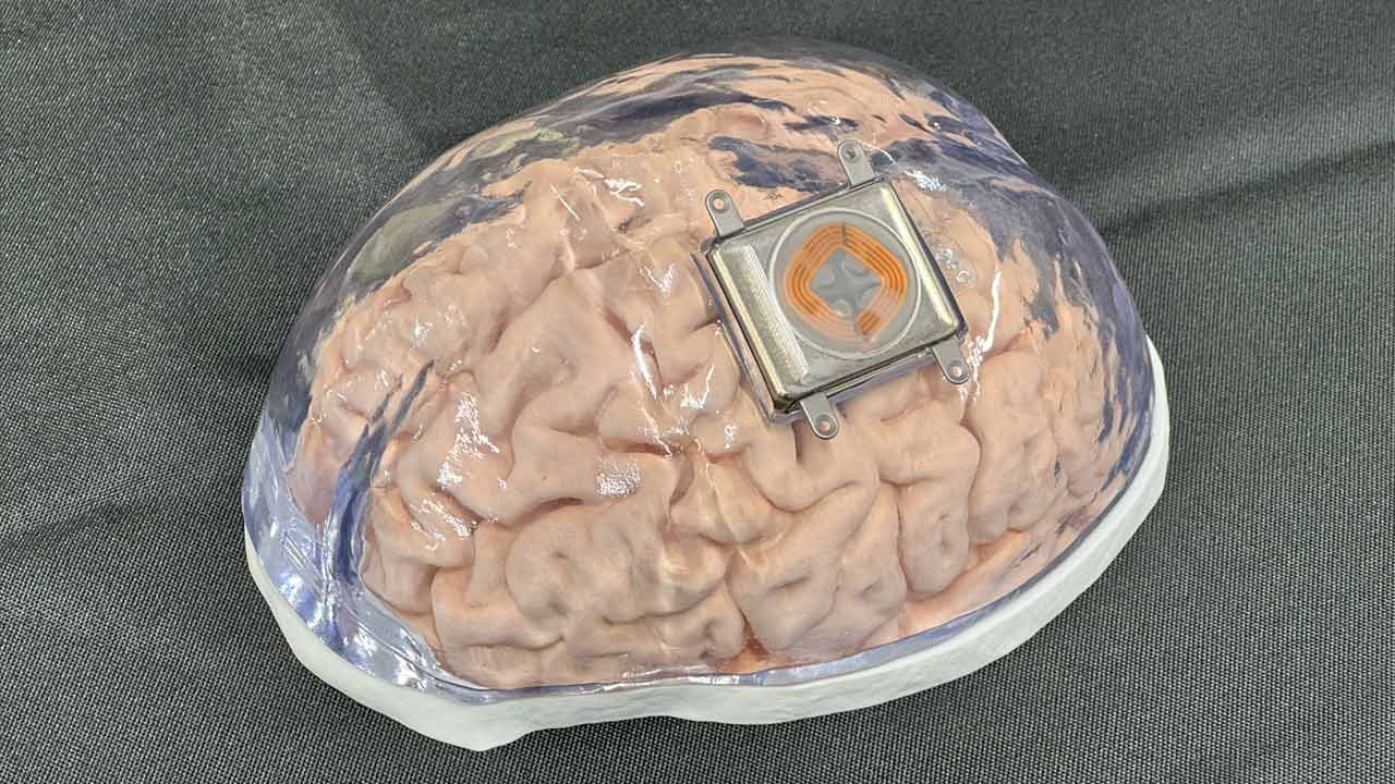 四肢まひ患者、脳から直接タブレット操作の現実味 頭部にチップ埋め込む：日経ビジネス電子版