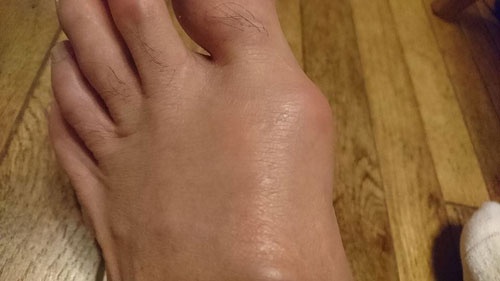 真っ赤に腫れた左親指関節。痛くて革靴も履けません。スーツにスニーカーという妙な格好で会社に行きました。