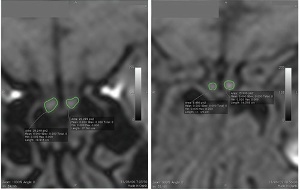 <b>顔断面を撮影したMRI画像。パーキンソン病患者の嗅球（右）は健常者（左）よりも小さい。 出所：東京都健康長寿医療センター</b>