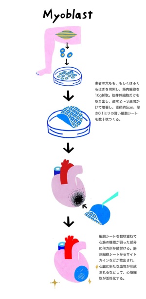 心筋シート 使う心臓病治療が始まった 日経ビジネス電子版