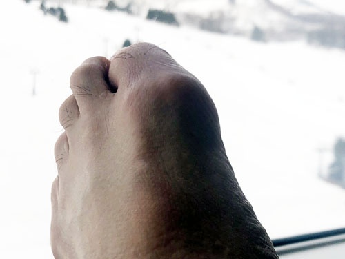 ご覧くださいこの腫れた足。「月に雁」ならぬ「雪に痛風」です。痛い。