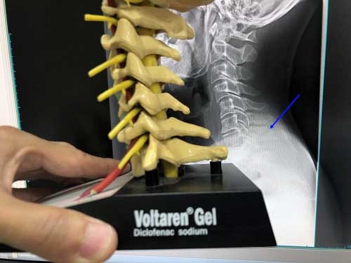 この模型の一番下の右に飛び出た長い骨。これがポッキリいってしまいました。外部から大きな衝撃が加わると、頚椎7番とその上の6番が衝突して、長い方の7番が折れる典型的な骨折です。ですが、ここ“だけ”がキレイに割れてしまうケースはまれだそうで、椎間板が潰れたり、頚椎そのものがズレて脊髄が損傷してしまうケースが多いのだそうです。ヤバかったー(・_・;)