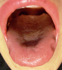 写真2◎　歯痕舌（提供：丁氏）