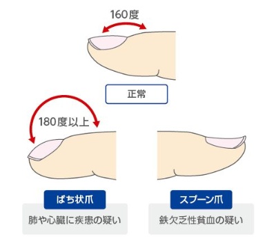 図2◎　ばち状爪（指）とスプーン爪も病気のサイン