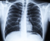 胸部エックス線検査を受けずに減給処分を受けることも。（©Thomas Hecker /123RF.com）