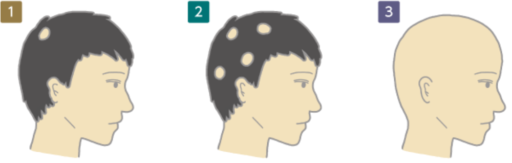 円形脱毛症になるのはストレスに弱いから 日経ビジネス電子版 円形脱毛症になるのはストレスに弱いから 日経ビジネス電子版