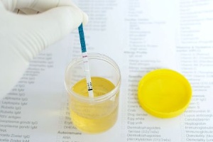 尿にたんぱく質が漏れ出る「たんぱく尿」が検出されると、腎臓の病気の可能性がある。 （©Jarun Ontakrai-123RF）