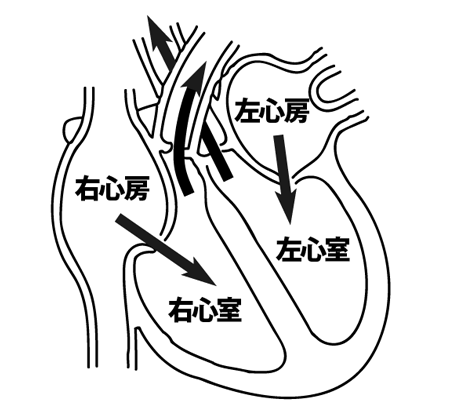 心臓は「右心房」「右心室」「左心房」「左心室」の4つの部屋に分かれている。左心室の筋肉が異常に厚くなるのが左室肥大だ。（矢印は血液の流れる方向を示す）