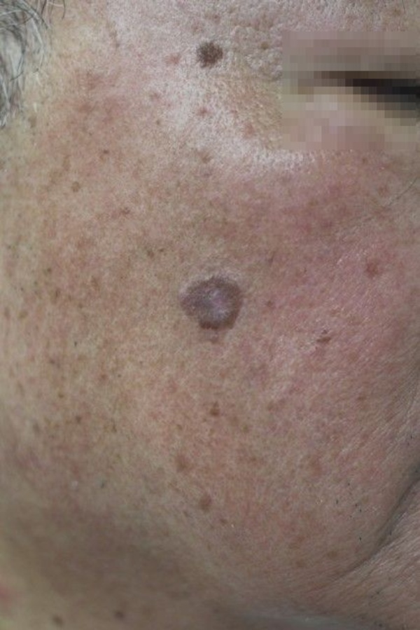 年寄り臭いシミやイボ 数千円の液体窒素治療も 日経ビジネス電子版 年寄り臭いシミやイボ 数千円の液体窒素治療も 日経ビジネス電子版