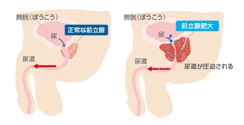前立腺肥大を起こすと尿道が圧迫される